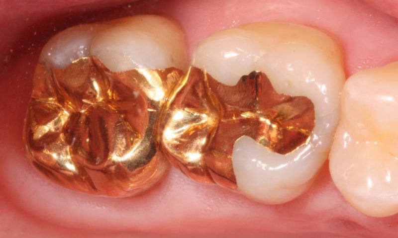 کانی طلا در دندانپزشکی